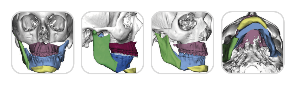 Cirugía Ortognática en Bogotá