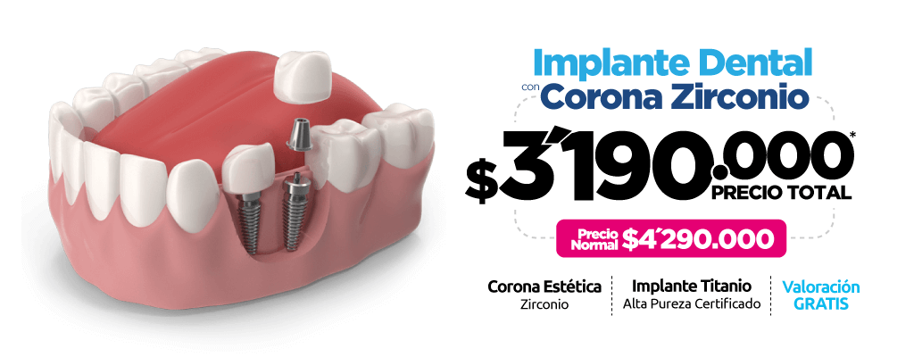 Implante Dental + Corona Zirconio $3.190.000